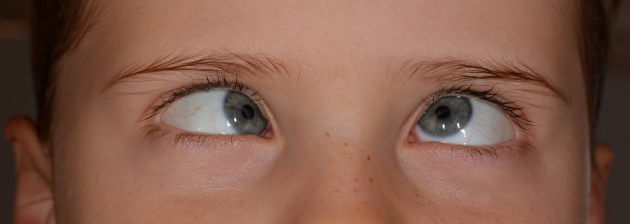 child, squint, look, deviation, offset, face, eyes, disease, childhood, eye doctor, play, wacky, funny, joke, joke, joke, humorous,